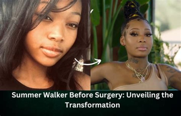 
Did Summer Walker Get Plastic Surgery? Here Is Why The Singer Looks So Different 
